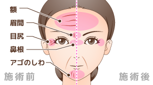 ボトックス注入