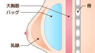 豊胸術：シリコンバッグ