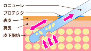 脂肪吸引