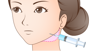 小顔形成・エラボトックス注入