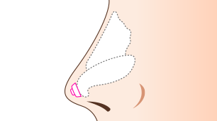 鼻尖延長術（軟骨移植）
