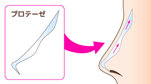 隆鼻術：鼻プロテーゼ・軟骨移植