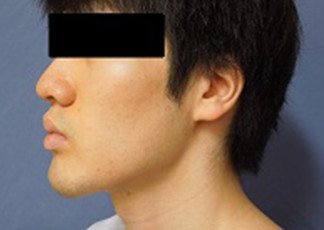 顎 アゴ あご 削り 美容外科 アゴ削りの横浜エーブクリニック