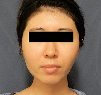 頬骨整形 頬骨削りに関する症例紹介やダウンタイム 後遺症の解説 美容外科 頬骨整形の横浜エーブクリニック